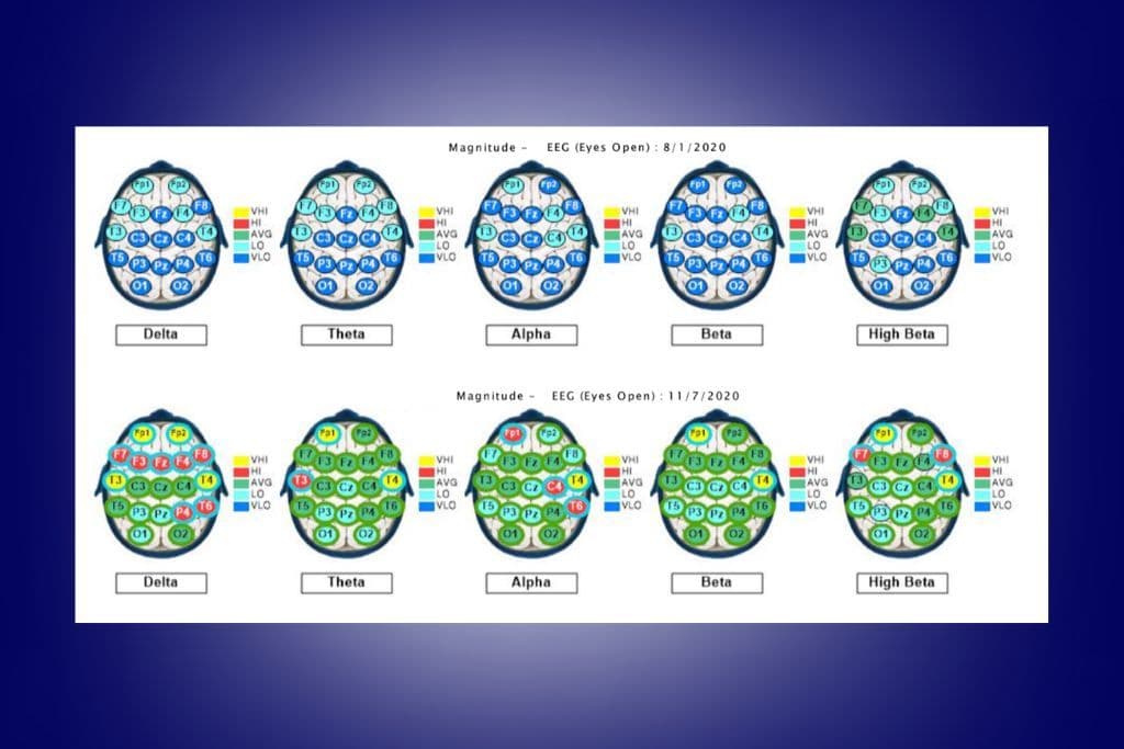 What a QEEG Brain Map Can Show You | Nervous System Regulation | E309