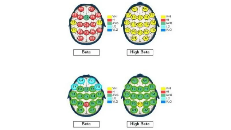 Four QEEG brain maps showing Beta and High Beta wave distributions