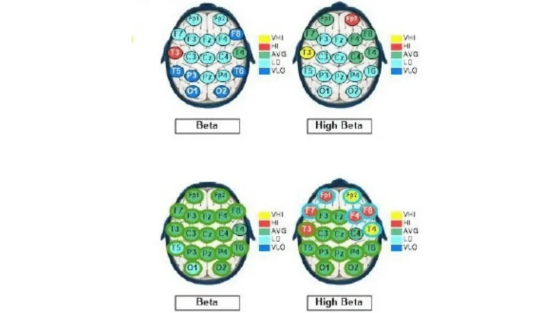 QEEG brain maps showing Beta, High Beta, and Delta frequency bands